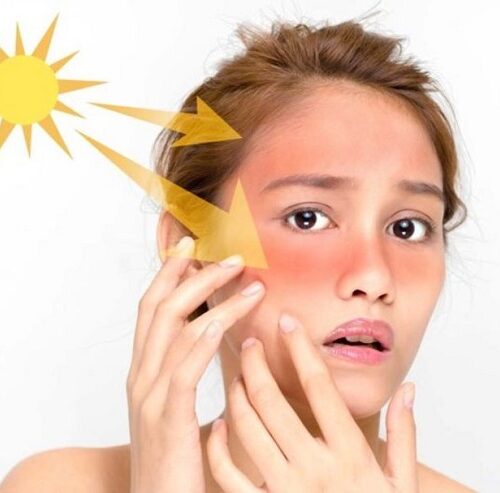 Cách khắc phục làn da bị cháy nắng sạm đen cấp tốc tại nhà