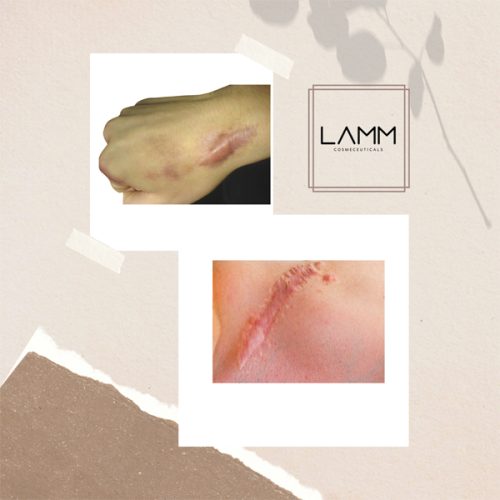 Vết thương lên da non bị thâm