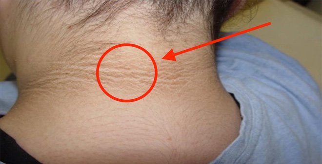Thứ tư, do vùng da ở cổ tiếp xúc với ánh nắng từ mặt trời
