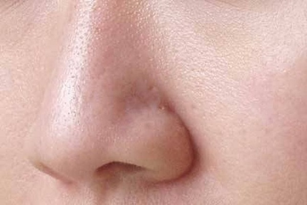 Sợi bã nhờn là gì?
