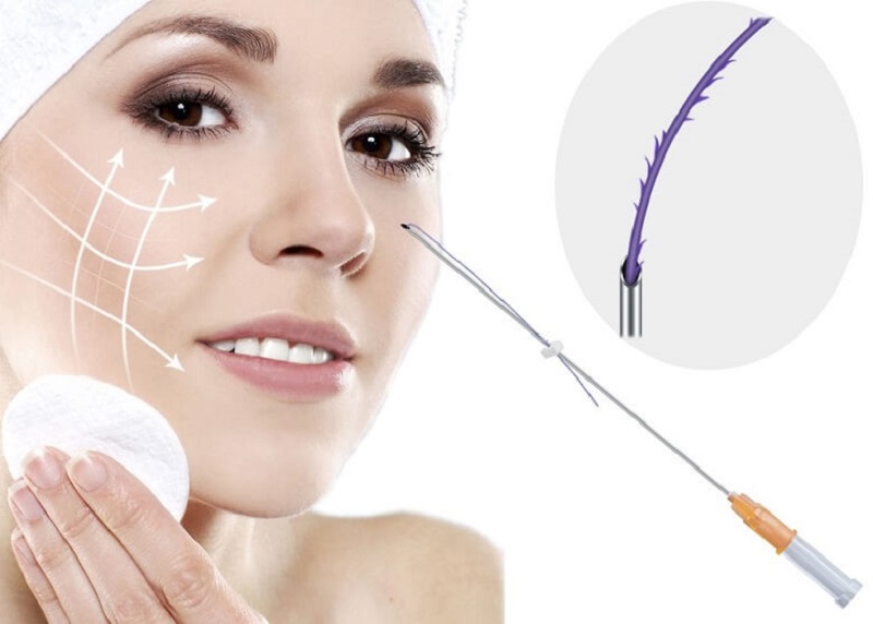 Căng chỉ collagen da mặt là phương pháp gì?