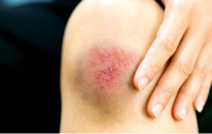 Các nguyên nhân khiến da non trở nên thâm sạm
