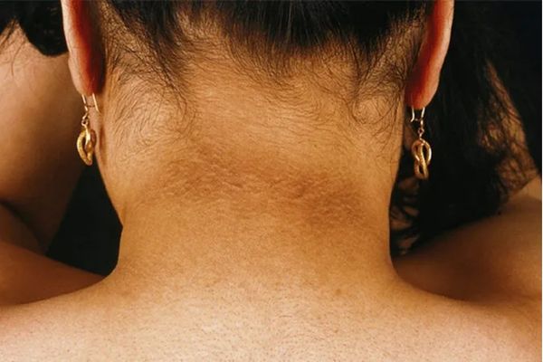 Thứ nhất, do tiết quá nhiều mồ hôi

