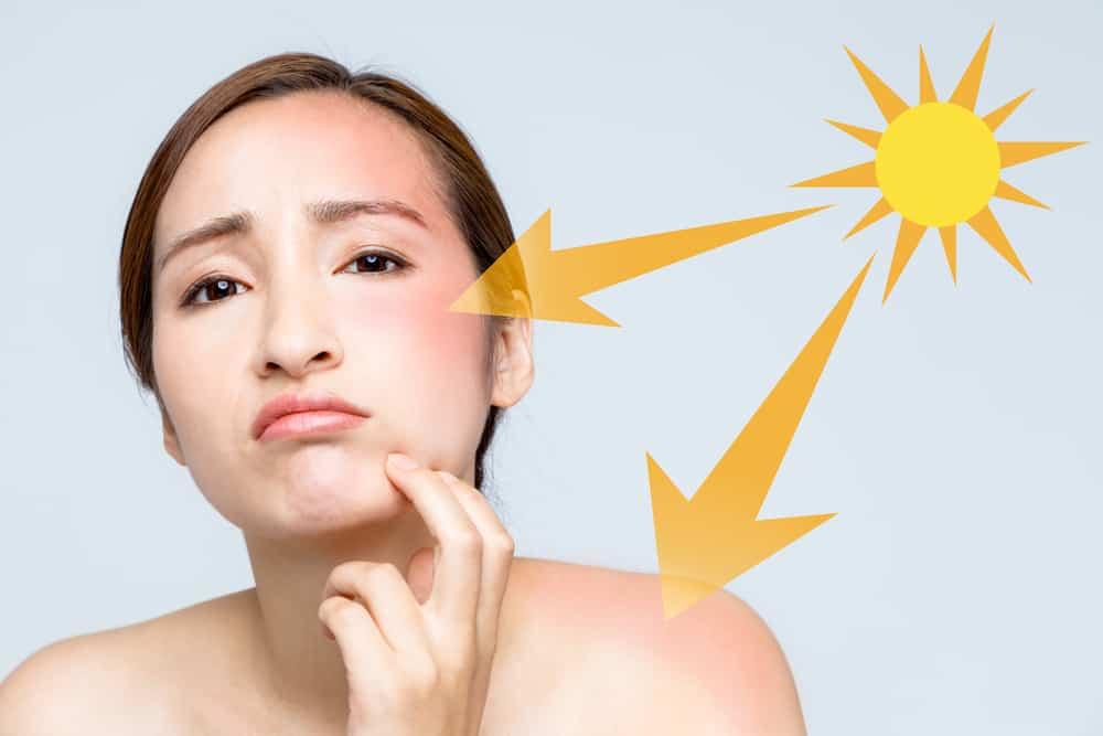 Về tính trạng cháy nắng
