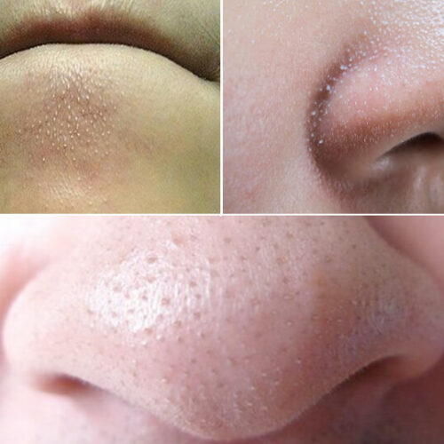 cách trị sợi bã nhờn trên mặt