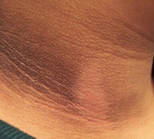 da cổ bị thâm đen: nguyên nhân và 10+ cách trị thâm cổ hiệu quả