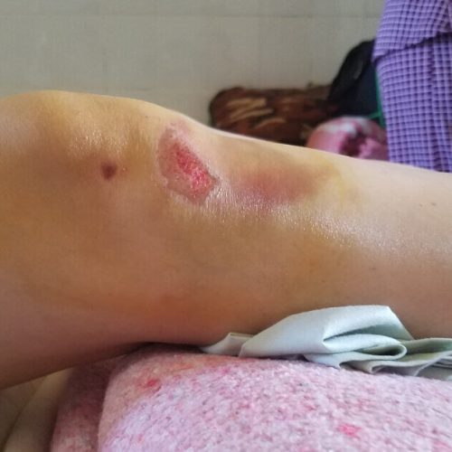 Vết thương lên da non bị thâm