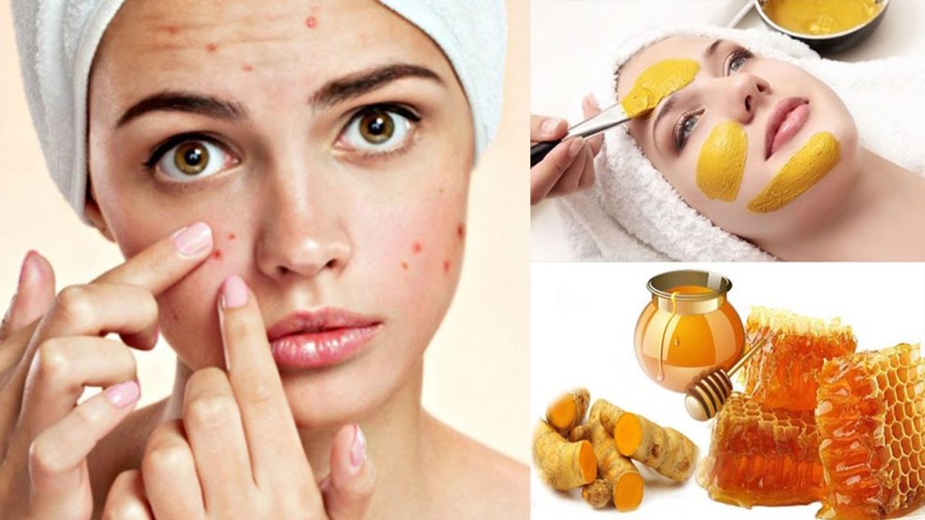Giảm mụn trứng cá bằng mật ong