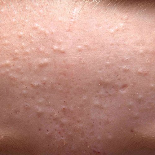 Góc giải đáp: Mụn ẩn - Nguyên nhân và cách xử lý hiệu quả