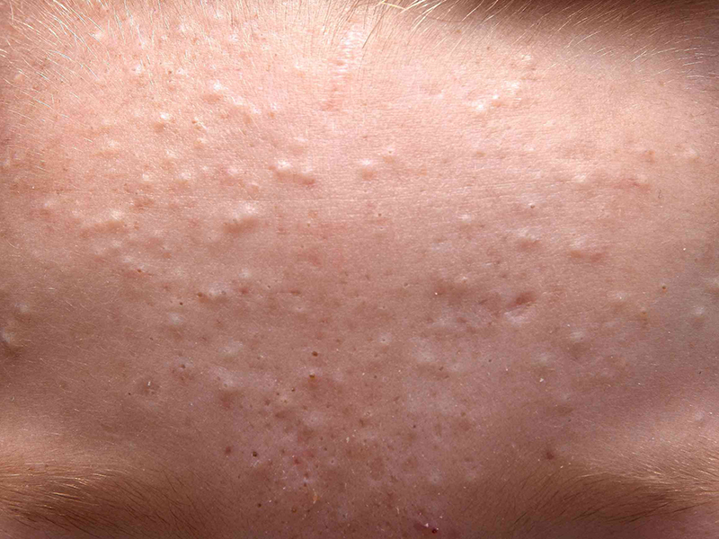 Góc giải đáp: Mụn ẩn - Nguyên nhân và cách xử lý hiệu quả