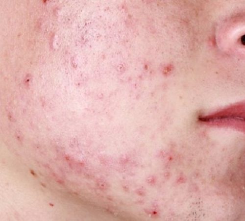 Nguyên nhân và cách điều trị mụn trứng cá hiệu quả tiết kiệm nhất