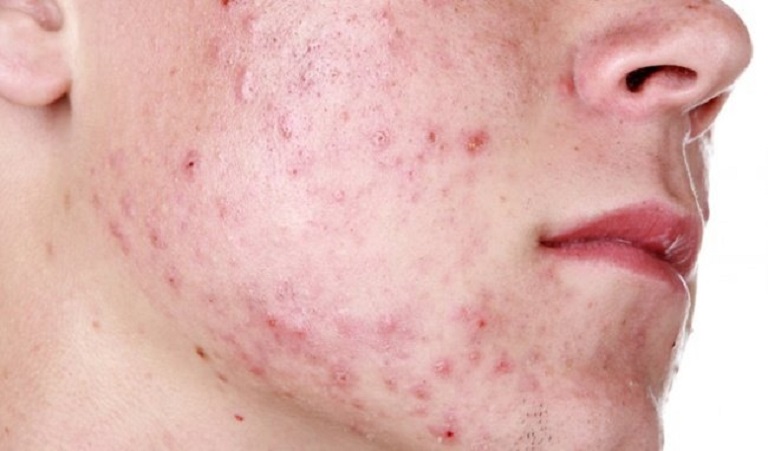 Nguyên nhân và cách điều trị mụn trứng cá hiệu quả tiết kiệm nhất