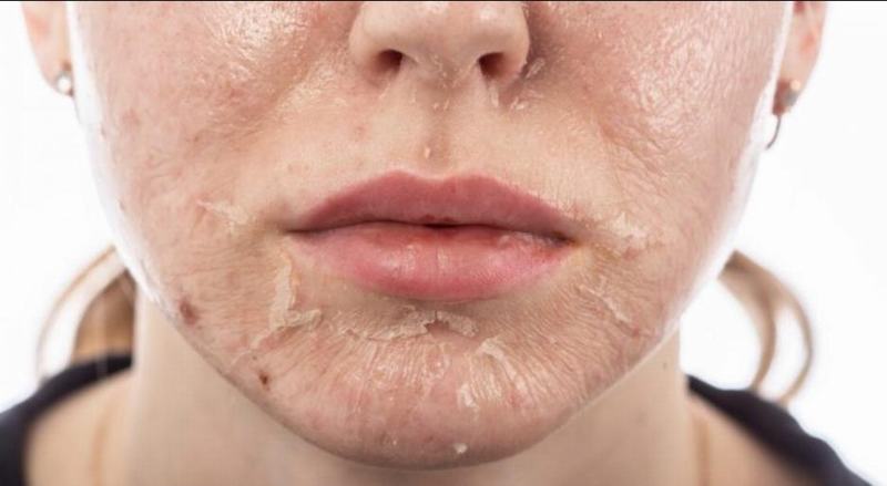Nguyên nhân da bị tăng sắc tố sau lăn kim