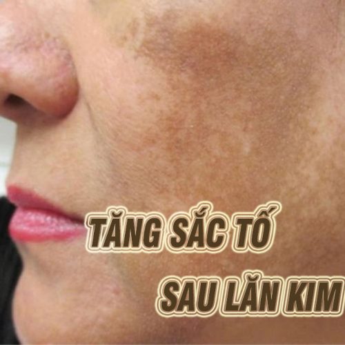 da bị tăng sắc tố sau lăn kim phải làm sao? Cách khắc phục