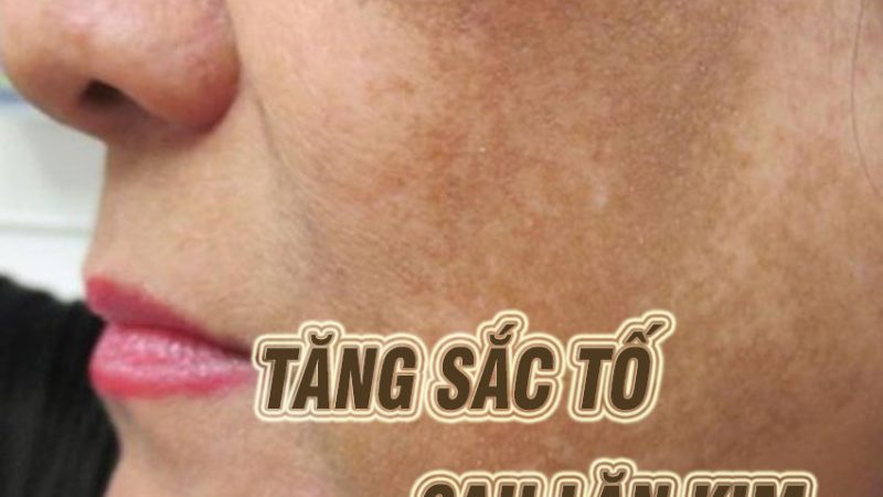 da bị tăng sắc tố sau lăn kim phải làm sao? Cách khắc phục