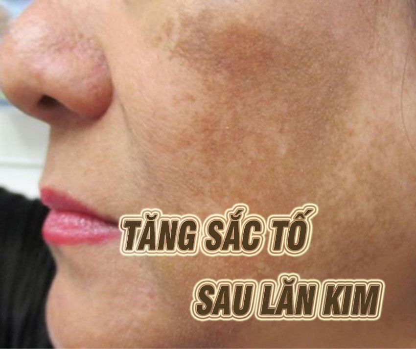 da bị tăng sắc tố sau lăn kim phải làm sao? Cách khắc phục
