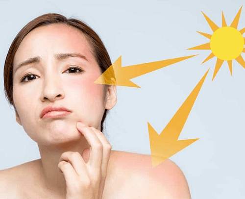 khắc phục làn da bị cháy nắng