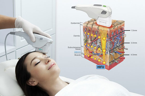Công nghệ Hifu smas