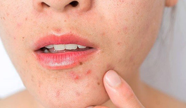 Không nên tẩy tế bào chết cho da mụn vào thời điểm nào?