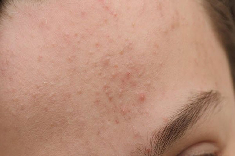 Mụn ẩn được hiểu như nào?