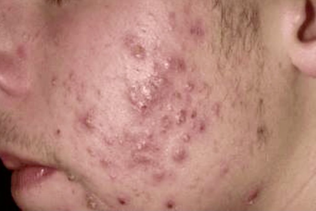 Mụn trứng cá - mụn mủ