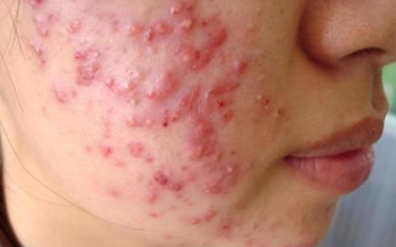 Nguyên nhân nào dẫn đến da bị mụn trứng cá?