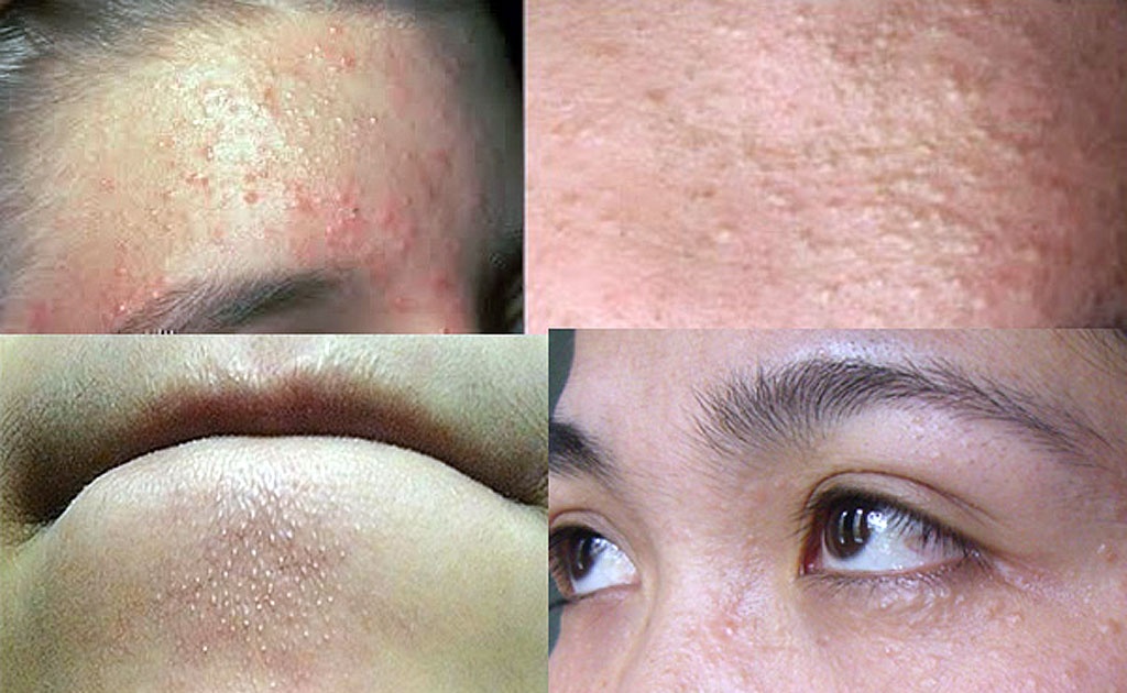 Điều gì khiến mụn ẩn tích tụ trên làn da của chúng ta?