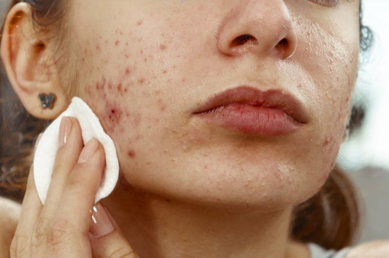 Vì sao lại bị mọc mụn trứng cá?