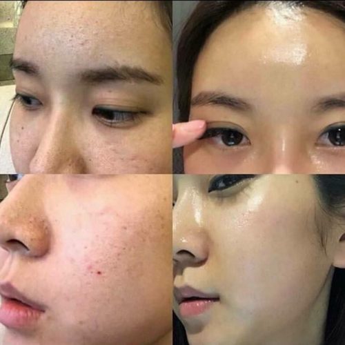 Chia sẻ bí kíp chăm sóc da hiệu quả: Bật mí cách kiềm dầu hiệu quả cho làn da nhờn mụn