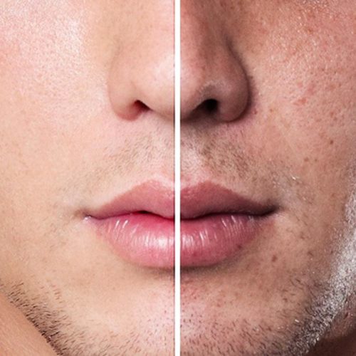 cách trị nám da mặt cho nam giới