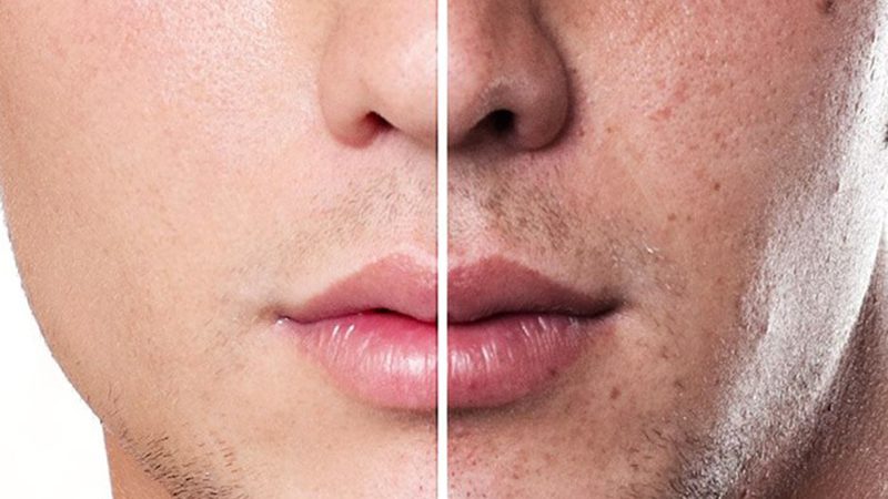 cách trị nám da mặt cho nam giới